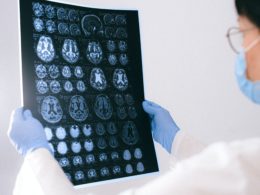 Breaking down work-related strokes: what they are, what you can do to prevent them, and what to do to receive workers' compensation.